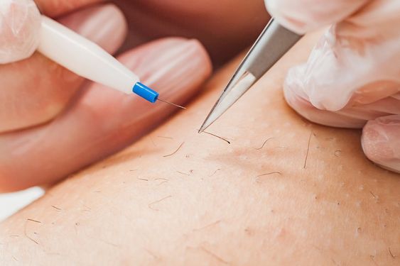 Electrolysis Hair Removal