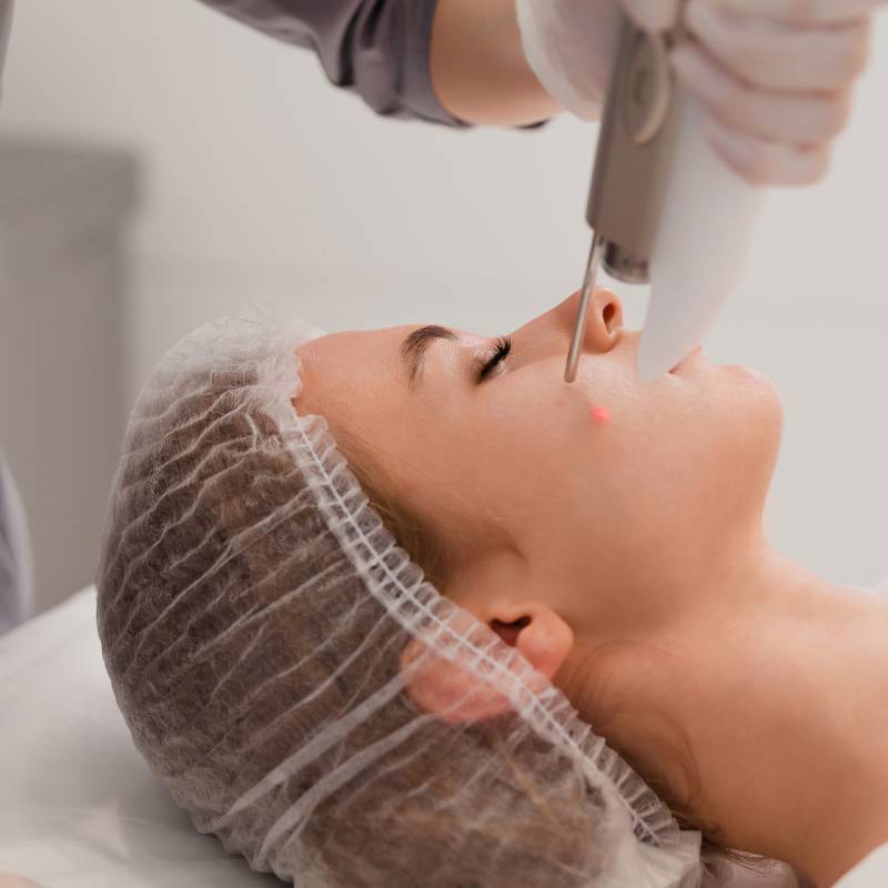 Laser Vessel Removal on Face and Body