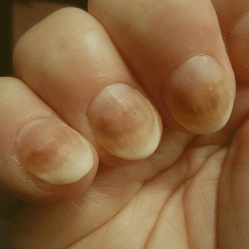 Nail Fungus (Onychomycosis) Treatment