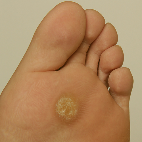 Treatment of corns